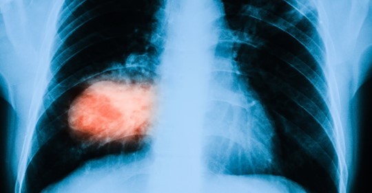 Salute - il Farmaco Sciogli Tumore ai Polmoni