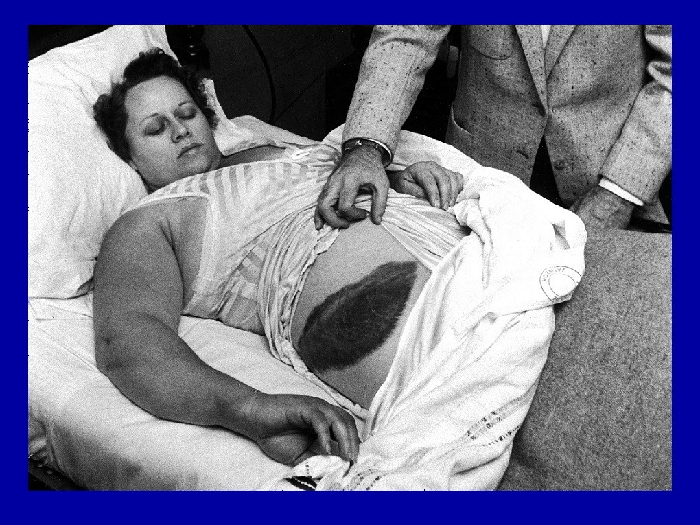 Accadde oggi - 30 Novembre 1954 - Prima persona colpita da un meteorite