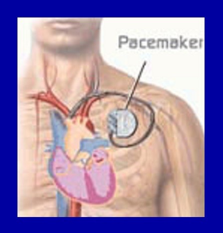 Accadde oggi - 8 Ottobre 1958 - Impiantato il primo pacemaker
