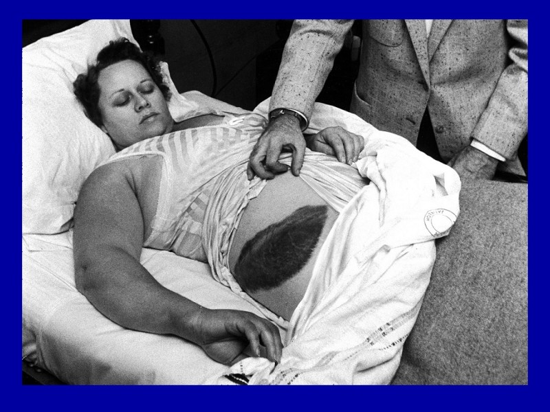 Accadde oggi - 30 Novembre 1954 - Prima persona colpita da un meteorite