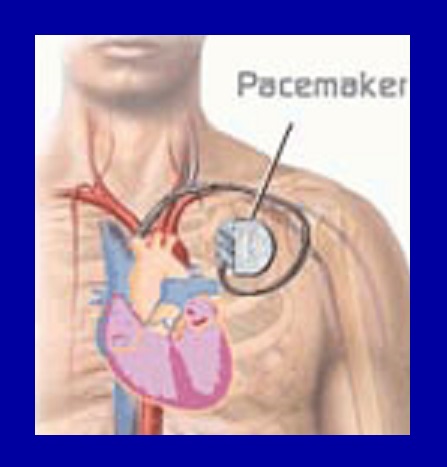 Accadde oggi - 8 Ottobre 1958 - Impiantato il primo pacemaker